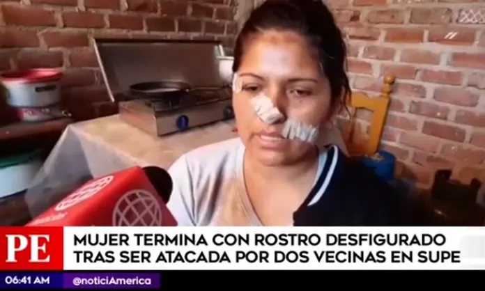 Supe Mujer Termina Con El Rostro Desfigurado Tras Ataque De Sus