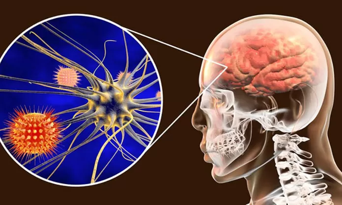 Cuáles son los síntomas de la meningitis y cómo se contagia