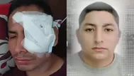 Carabayllo: Sujeto desfigura el rostro a un joven con una botella