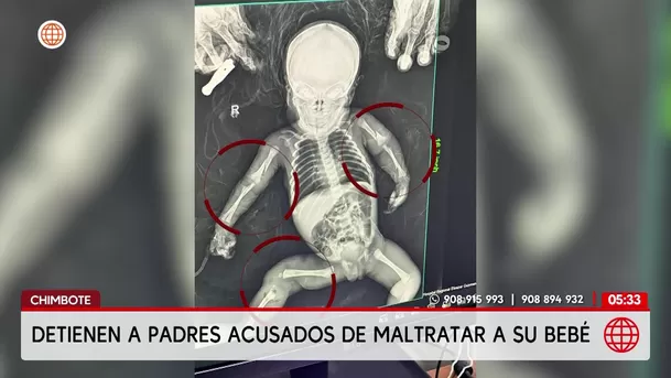 Chimbote: Detienen a padres acusados de fracturar los brazos y pierna a su bebé. Foto: América Noticias