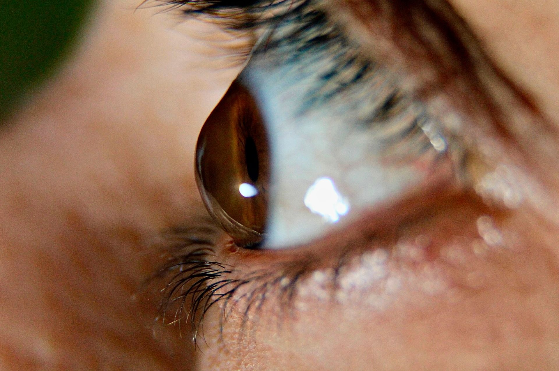 Enfermedad ocular queratocono. Foto: Difusión