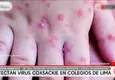 Detectan casos de virus coxsackie en colegios de Lima