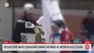 Escolar de 9 años sufre quemaduras de tercer grado en Piura