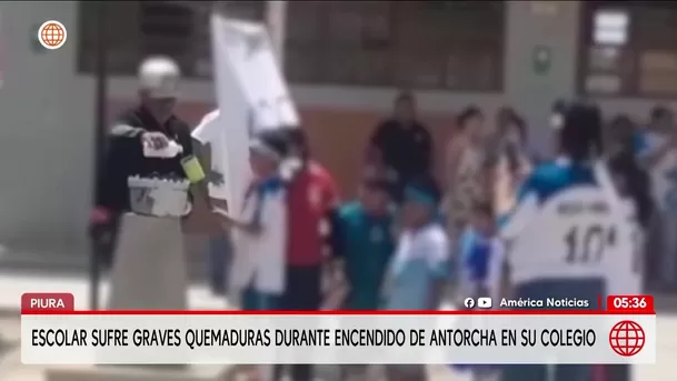 Escolar de 9 años sufre quemaduras de tercer grado en Piura. Foto: América Noticias Escolar de 9 años sufre quemaduras de tercer grado en Piura. Foto: América Noticias