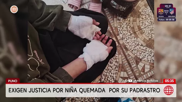 Exigen justicia por niña que sufrió quemaduras en Puno. Foto: América Noticias