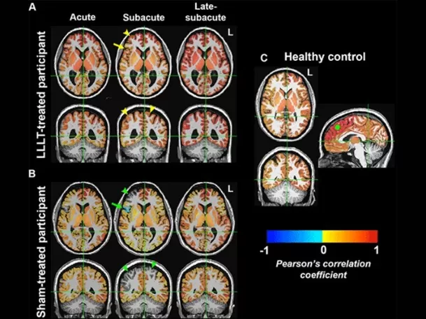 La fototerapia ayudaría a recuperación de lesiones cerebrales importantes. Foto: Radiology La fototerapia ayudaría a recuperación de lesiones cerebrales importantes. Foto: Radiology