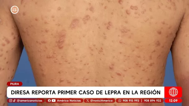 Diresa reporta primer caso de lepra en la región Piura. Foto: América Noticias