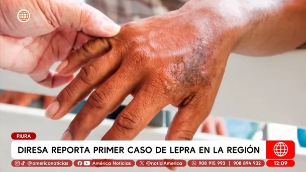 Diresa reporta primer caso de lepra en la región Piura. Foto: América Noticias