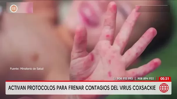 Minsa y Minedu activan protocolos por brote del virus Coxsackie. Foto: América Noticias