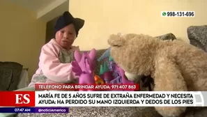 María Fe es el único caso de ictiosis arlequín en el Perú.