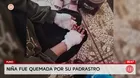 Niña fue quemada por su padrastro en Puno