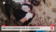 Niña fue quemada por su padrastro en Puno