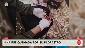 Niña fue quemada por su padrastro en Puno. Foto y video: América Noticias