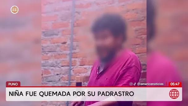 Niña fue quemada por su padrastro en Puno. Foto: América Noticias