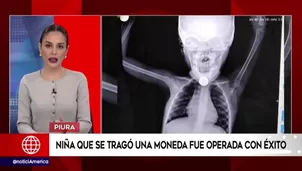 Luego de varias horas de intervención, los médicos de dicho nosocomio sustrajeron la moneda, salvándole la vida a la menor de edad