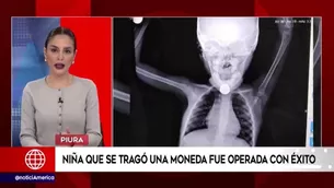 Luego de varias horas de intervención, los médicos de dicho nosocomio sustrajeron la moneda, salvándole la vida a la menor de edad