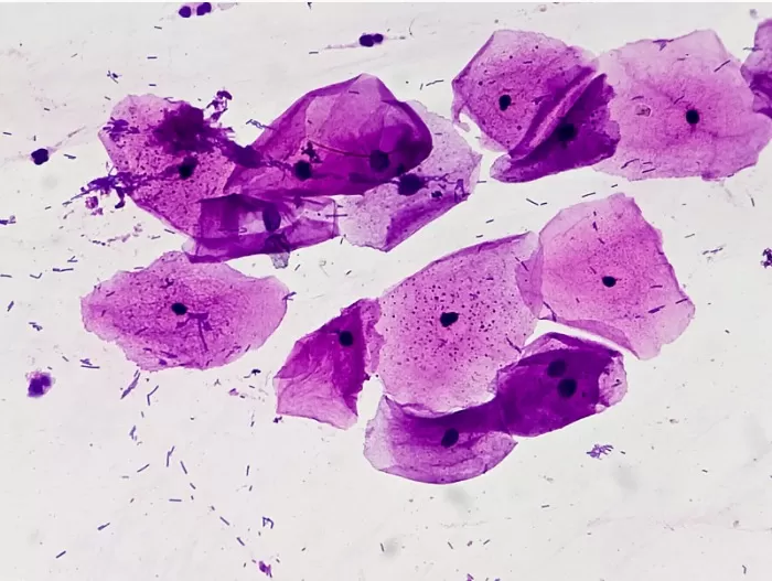 Nueva prueba no invasiva para detectar el cáncer oral. Foto: Cell Reports Medicine