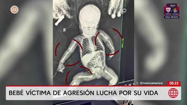 Dictan prisión preventiva contra padres por presunto maltrato a su bebé. Foto: América Noticias
