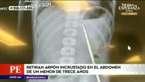 Médicos retiran arpón de abdomen de adolescente en Tarapoto. Foto y video: América Noticias