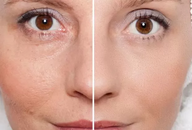 como cerrar los poros abiertos