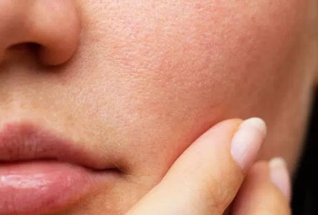 como quitar los poros abiertos