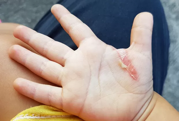 quemaduras de primer grado