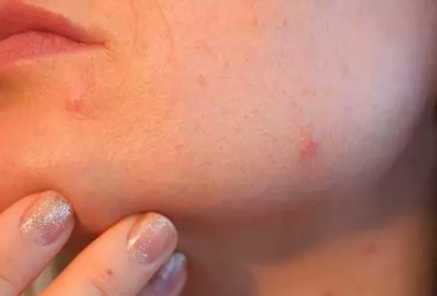 acne por uso de mascarilla