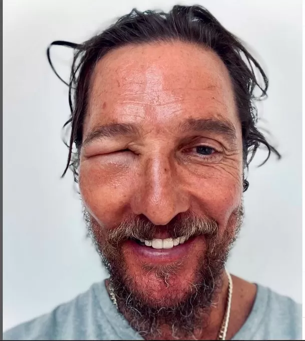 Matthew McConaughey  tuvo una reacción alérgica por la picadura de una abeja/Foto: Instagram