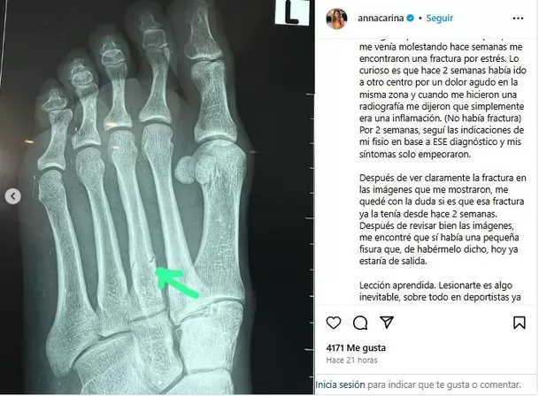 Radiografía que confirmó la fractura por estrés en el pie de Anna Carina. Foto: Instagram Radiografía que confirmó la fractura por estrés en el pie de Anna Carina. Foto: Instagram