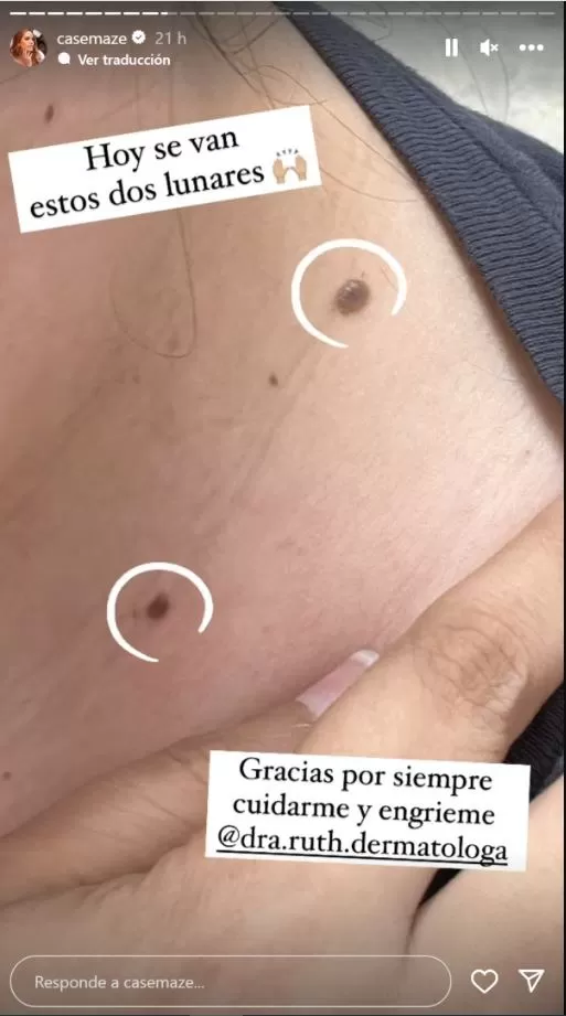 Cassandra Sánchez se sometió a una cirugía ambulatoria para retirarse unos lunares/Foto: Instagram