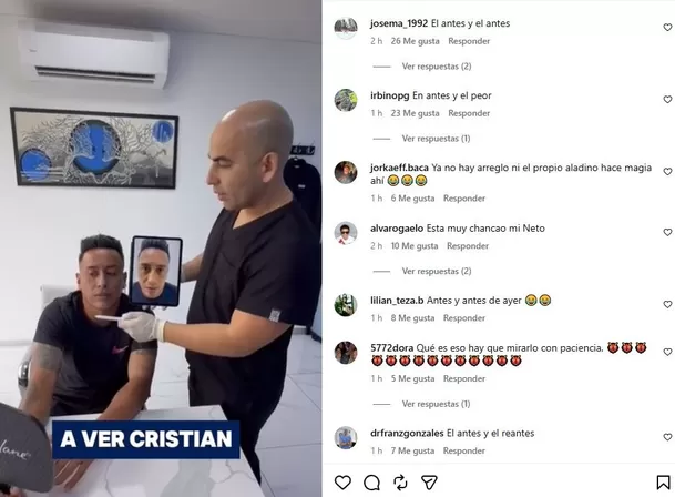 Christian Cueva se realiza retoque estético y usuarios se burlan / Instagram