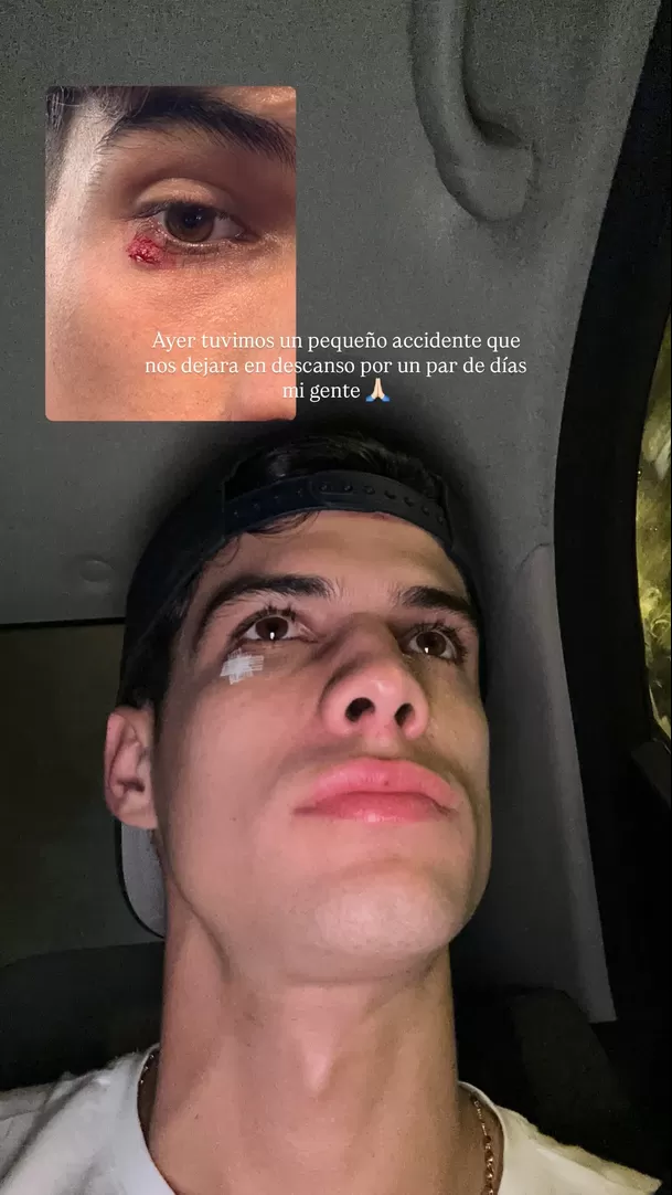 Kevin Díaz sufrió accidente y compartió imágenes de su rostro / Instagram Kevin Díaz sufrió accidente y compartió imágenes de su rostro / Instagram