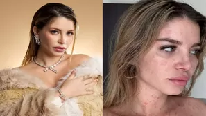 La cantante e influencer Flavia Laos compartió con sus seguidores cómo sobrelleva la enfermedad / América Espectáculos