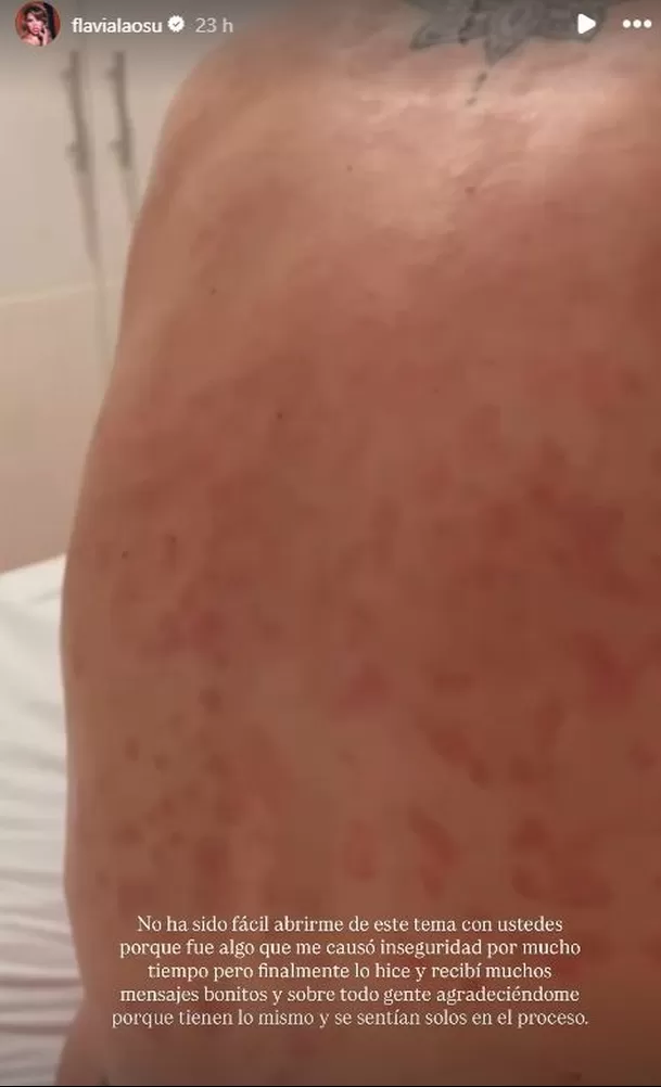 Flavia Laos dejó un mensaje por el Día Internacional de la psoriasis / Captura Flavia Laos dejó un mensaje por el Día Internacional de la psoriasis / Captura