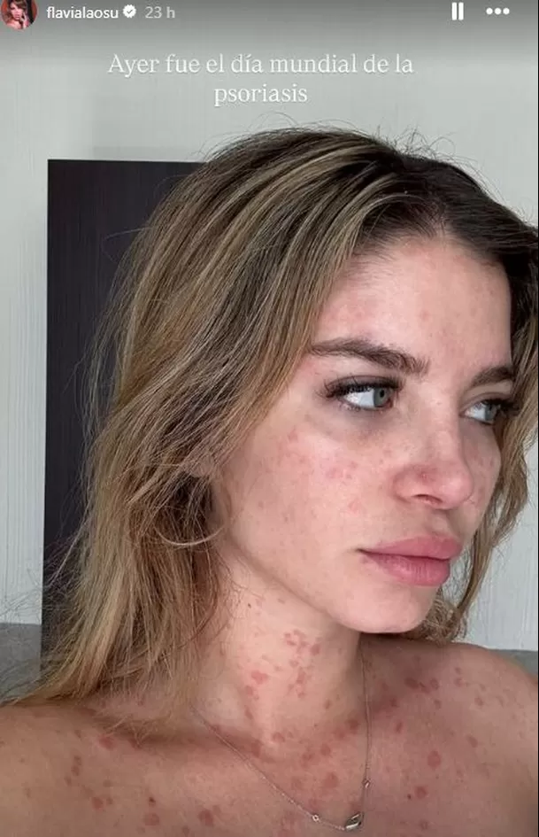 Flavia Laos reflexionó acerca de la psoriasis / Instagram Flavia Laos reflexionó acerca de la psoriasis / Instagram