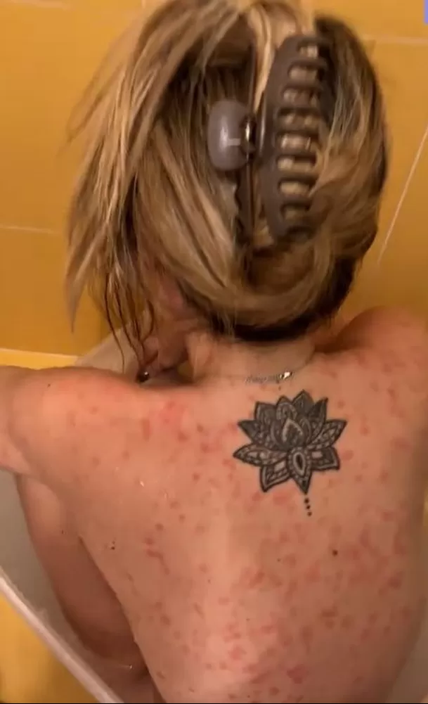 Flavia Laos mostró cómo la soriasis afecta su cuerpo / Captura