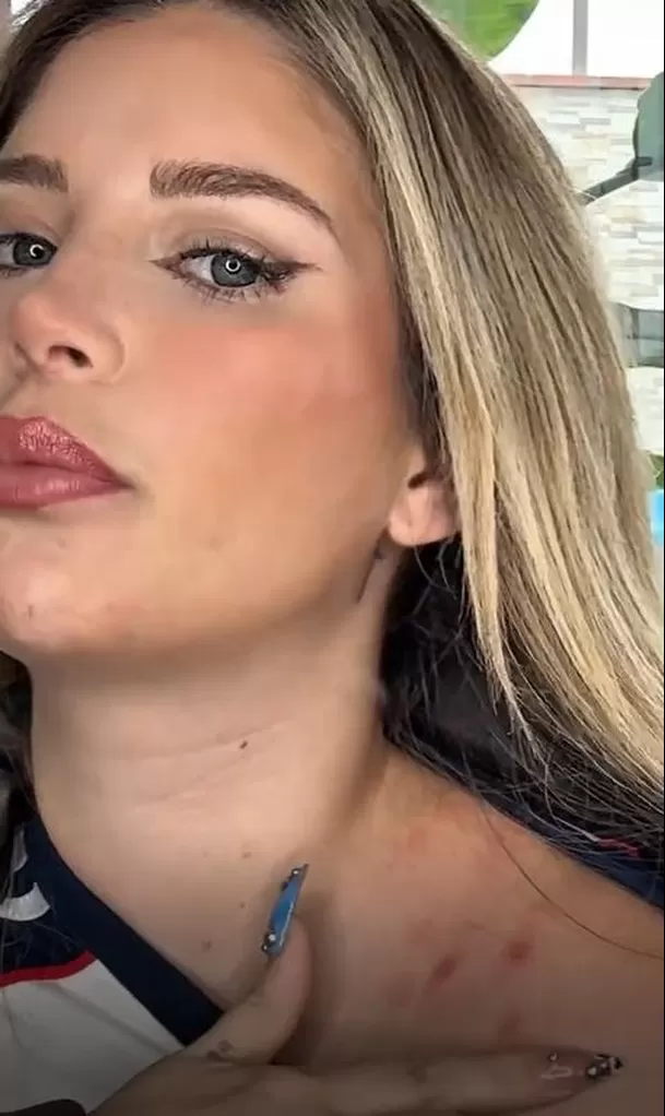 Flavia Laos reveló que la soriasis volvió después de un año / Captura