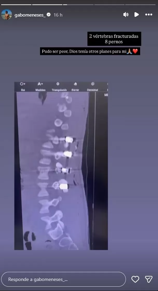 El integrante de EEG sorprendió a sus seguidores al compartir imágenes de su columna tras ser operado de emergencia. Video: Instagram
