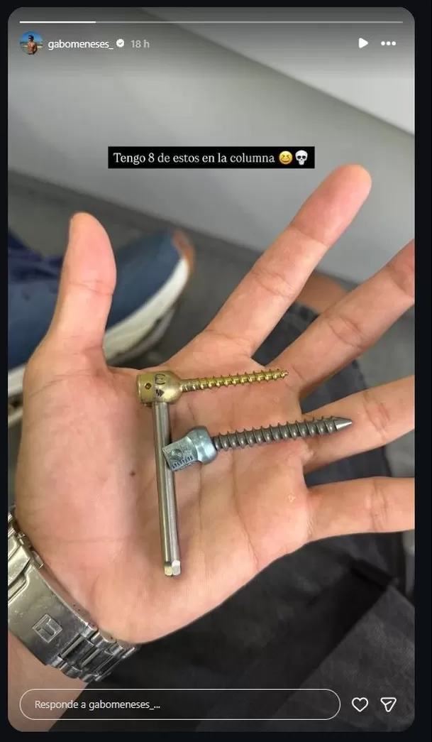 Gabriel Meneses evidencia la magnitud de la cirugía a la que fue sometido. Video: Instagram @gabomeneses_