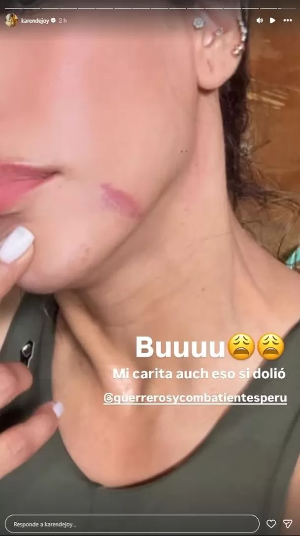 Karen Dejo mostró cómo quedó su rostro tras sufrir fuerte golpe / Instagram