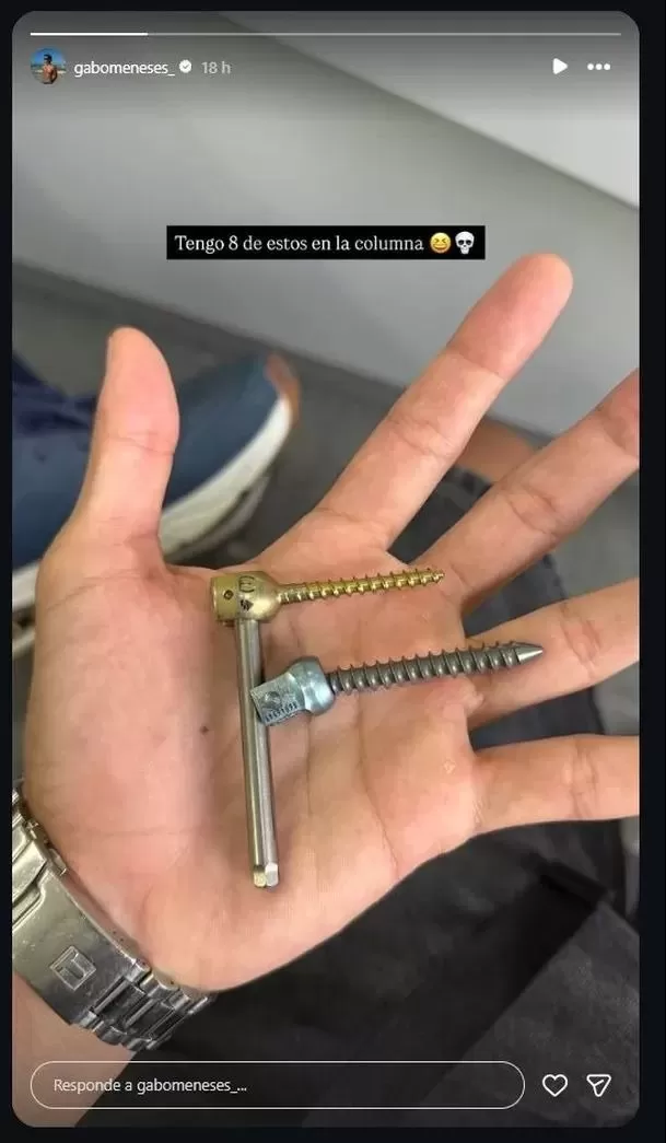 Gabriel Meneses evidencia la magnitud de la cirugía a la que fue sometido. Video: Instagram @gabomeneses_