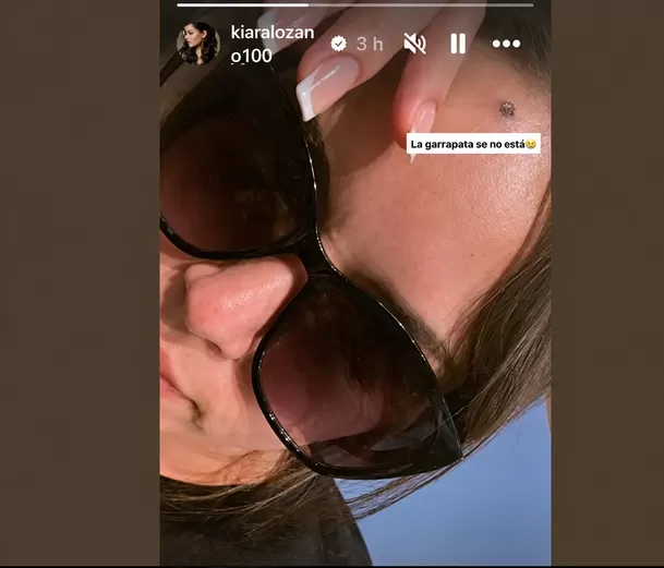 Kiara Lozano mostró el resultado de su cirugía estética / IG: @kiaralozano100 Kiara Lozano mostró el resultado de su cirugía estética / IG: @kiaralozano100
