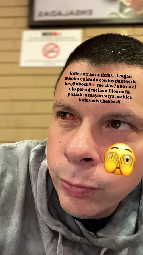 Así quedó el ojo derecho de Mario Hart tras un incidente con un globo/Foto: Instagram