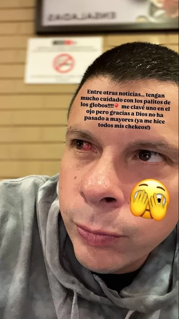 Así quedó el ojo derecho de Mario Hart tras un incidente con un globo/Foto: Instagram