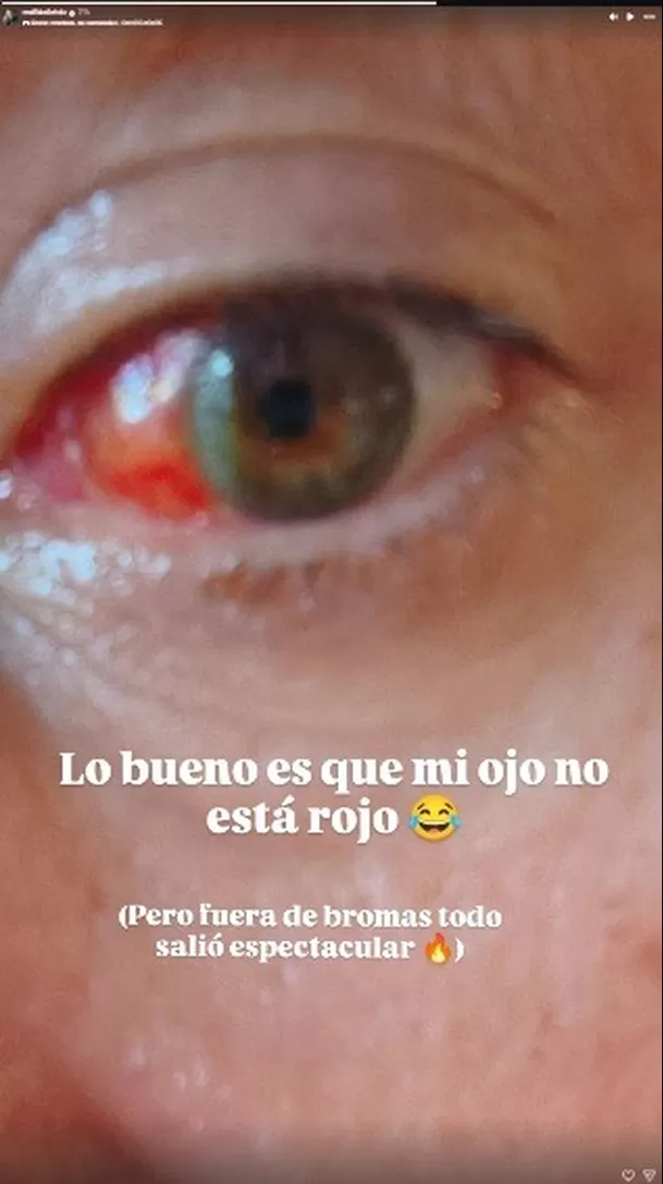 Mathías Brivio muestra cómo quedó su ojo tras intervención / Instagram: IGmathiasbrivio Mathías Brivio muestra cómo quedó su ojo tras intervención / Instagram: IGmathiasbrivio