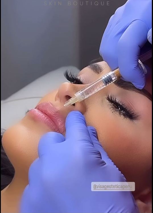 Michelle Soifer realizándose el aumento de volúmen de sus labios/Foto: Instagram 