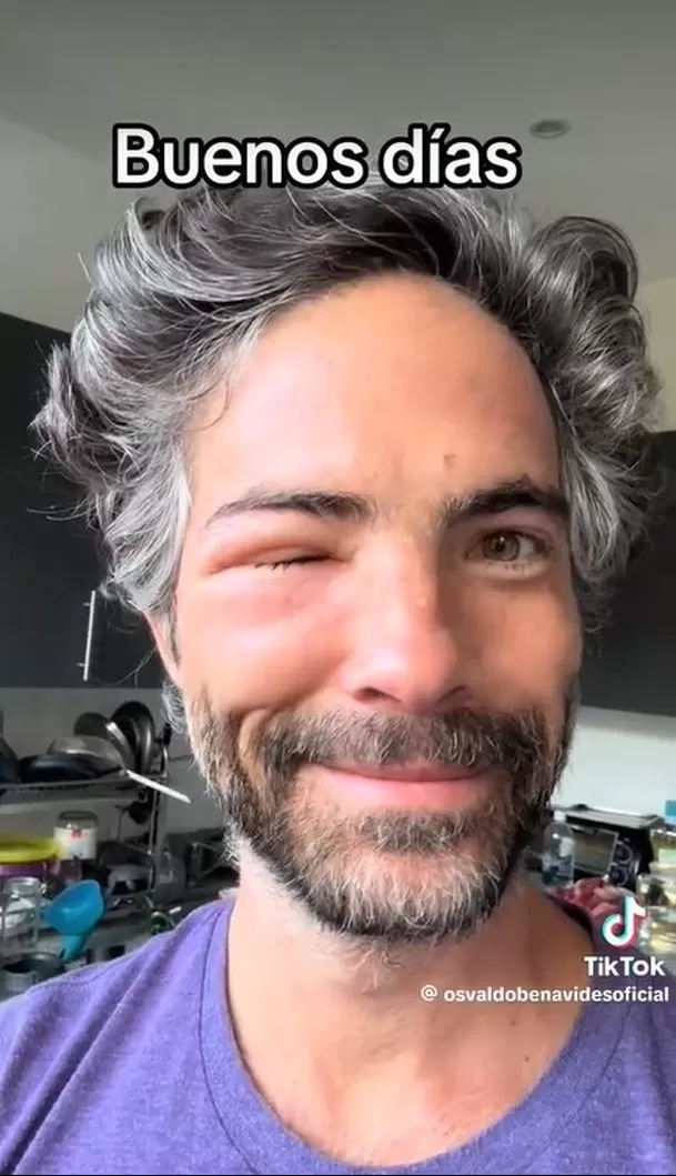 Nandito apareció con el rostro desfigurado: ¿Qué le pasó? Foto: TikTok/@osvaldobenavides