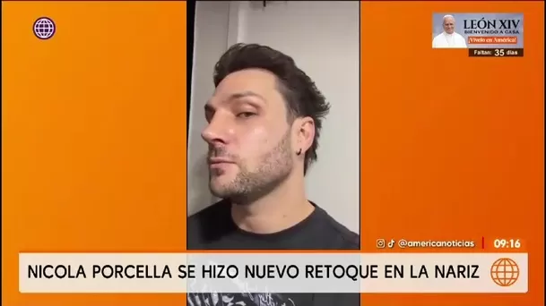 Nicola Porcella se hizo un nuevo retoque en la nariz/ América TV Nicola Porcella se hizo un nuevo retoque en la nariz/ América TV