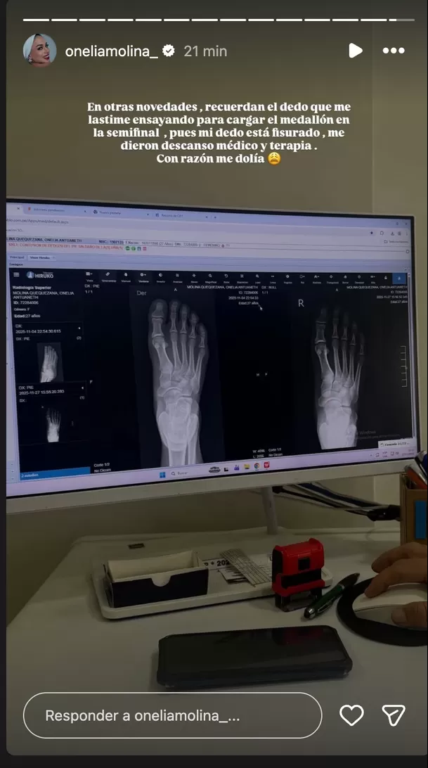 Onelia Molina compartió su radiografía en redes sociales. Foto: Instagram Onelia Molina compartió su radiografía en redes sociales. Foto: Instagram
