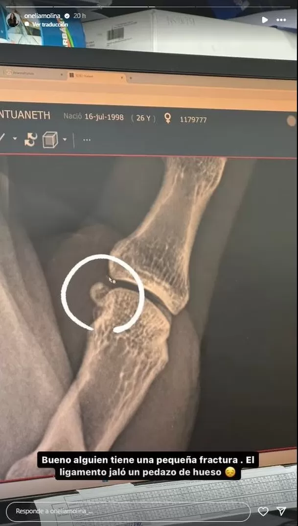 Onelia Molina sufrió lesión durante la competencia en Esto es Guerra. Fuente: Instagram Onelia Molina sufrió lesión durante la competencia en Esto es Guerra. Fuente: Instagram